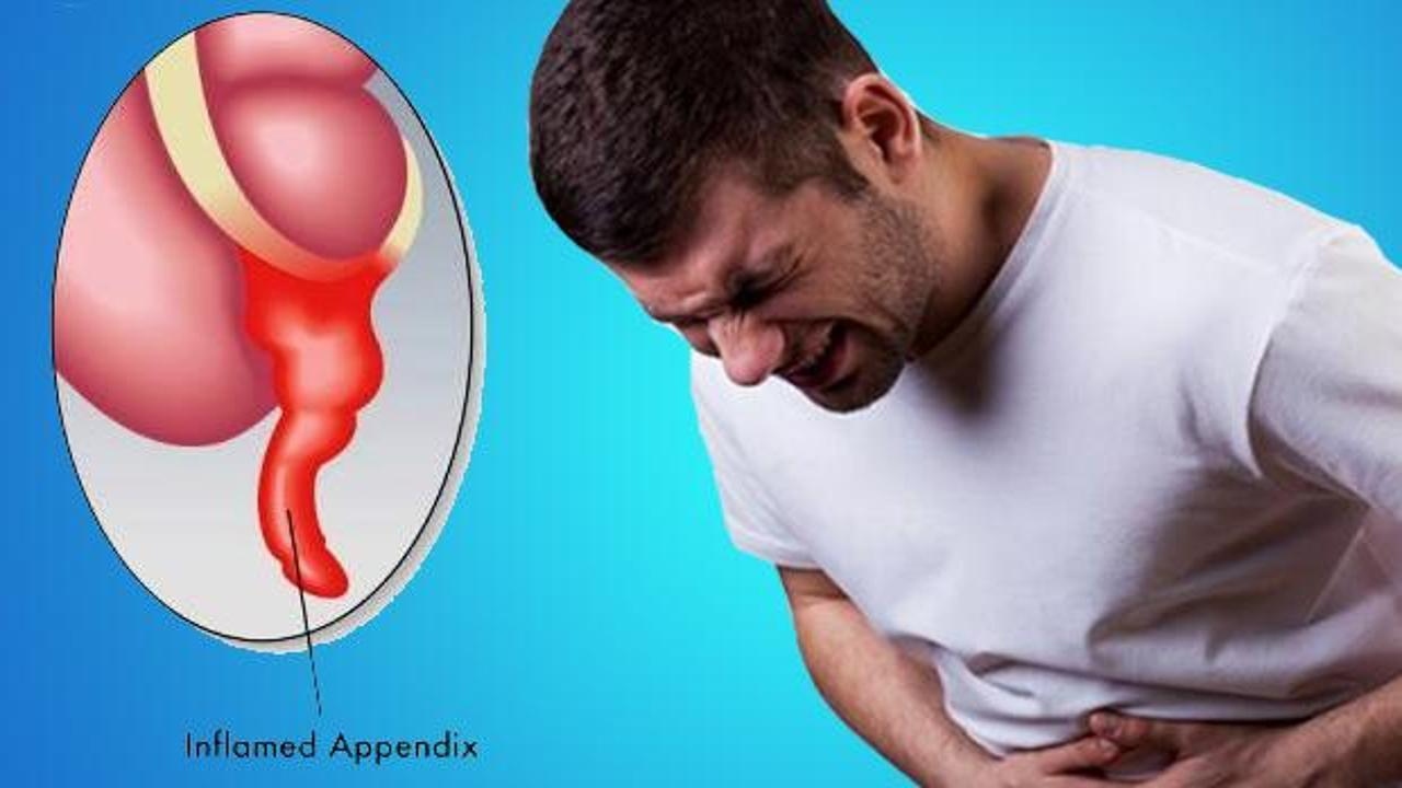 Apandisit Nedir Belirtileri Nele