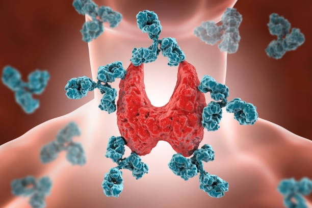 Autoimmune Thyroiditis Conceptua